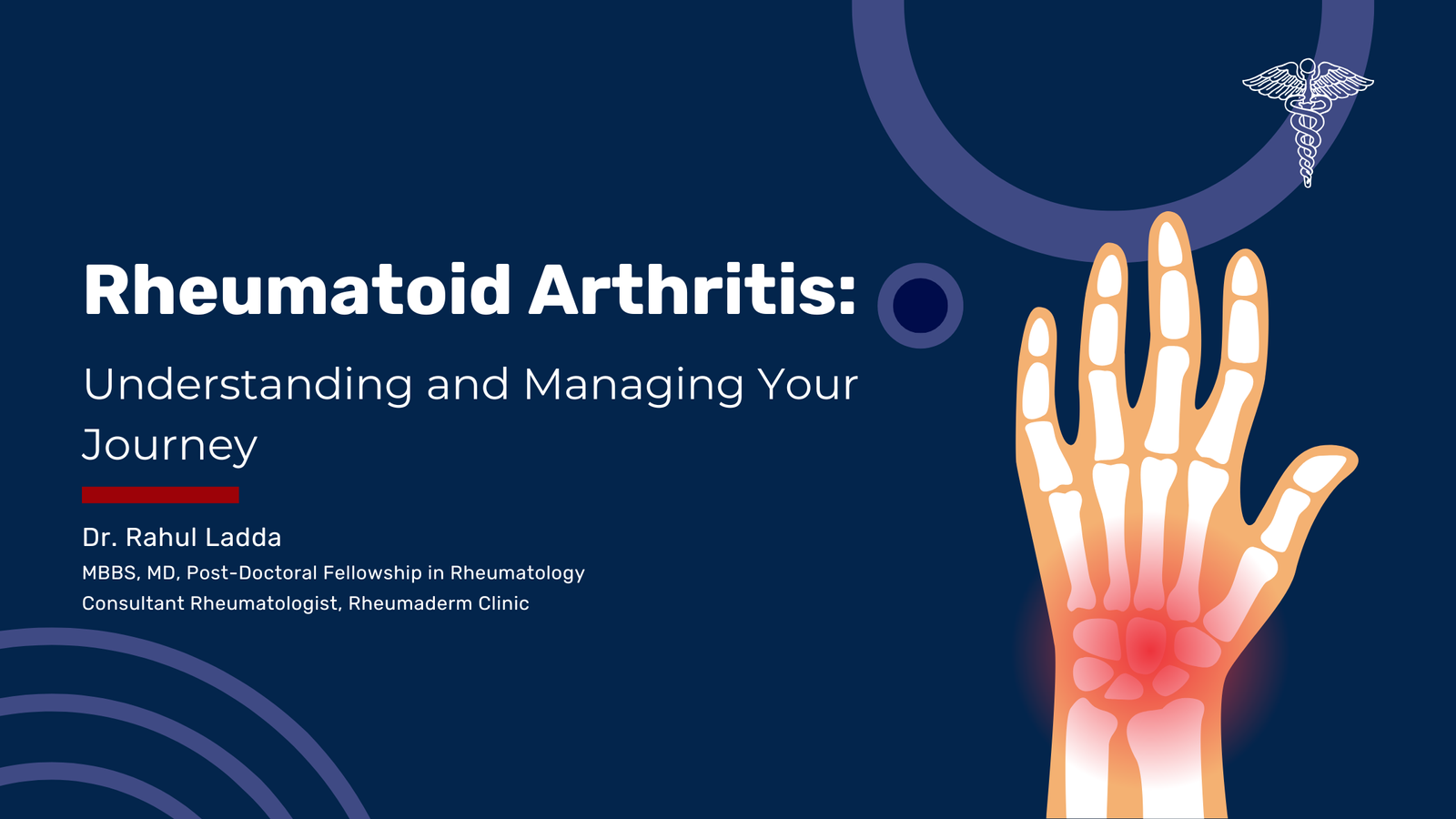 Rheumatoid Arthritis