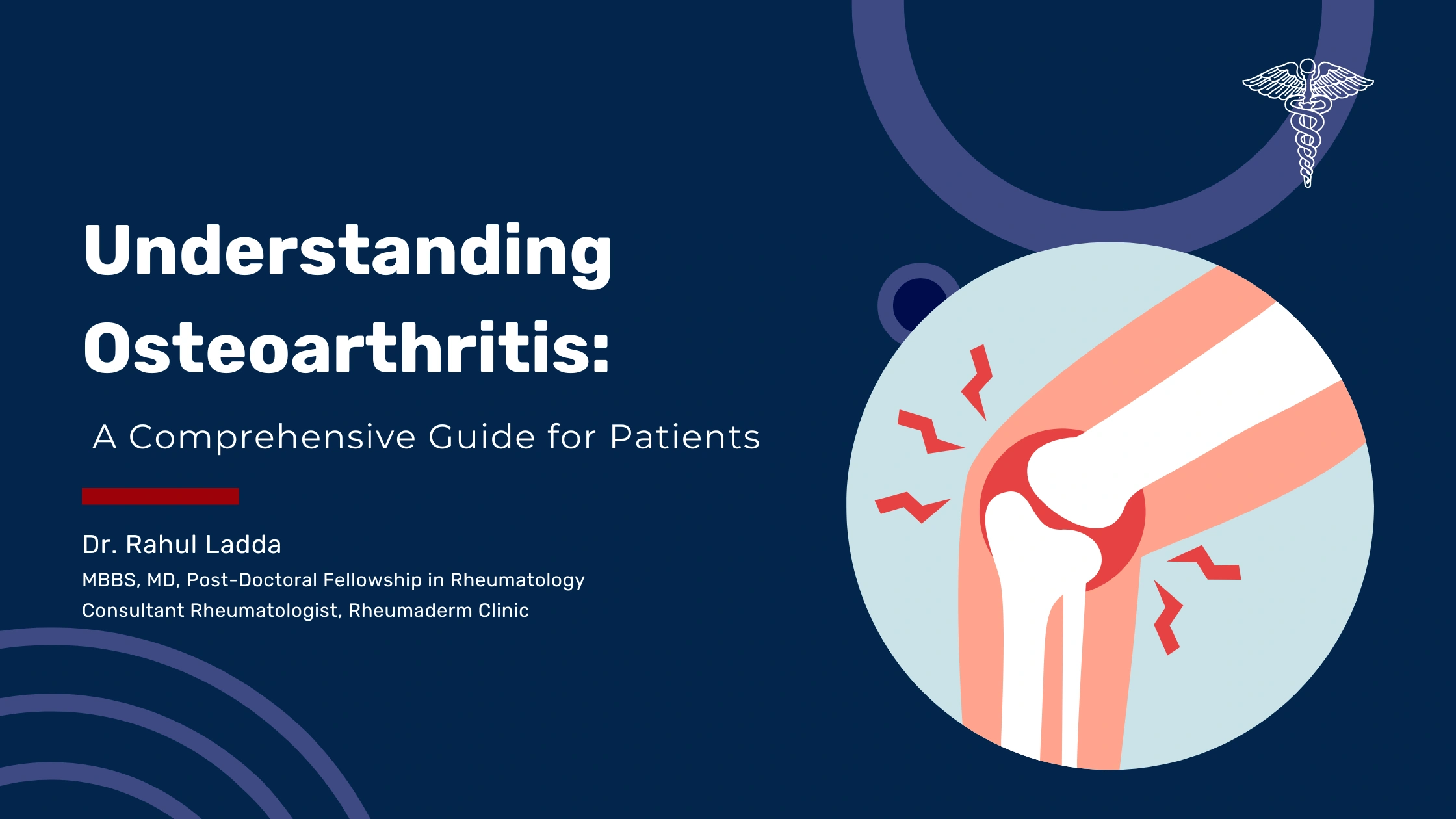 Understanding Osteoarthritis: A Comprehensive Guide for Patients